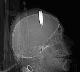 Afghan soldier took 14.5mm bullet to head and survived!